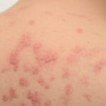A Deep Dive into Pruritus