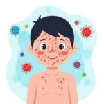 Measles: A Stubborn Sickness, Our Shared Challenge